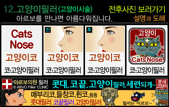 비순각필러,인중필러,고양이필러,고양이수술,고양이시술 ,고양이필러효과,코기둥,인중