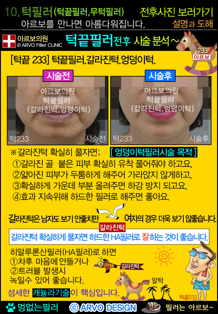 턱끝필러,비대칭턱끝교정,브이라인,턱끝필러,브이라인필러,브이라인턱필러,턱필러,브이라인턱