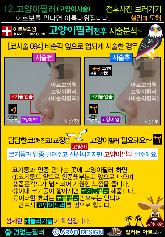 비순각필러,인중필러,고양이필러,고양이수술,고양이시술 ,고양이필러효과,코기둥,인중