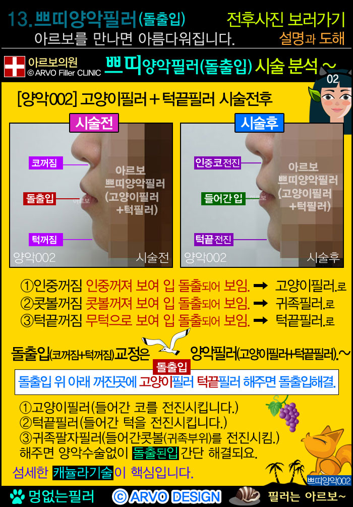 돌출입필러3가지,돌출입필러,쁘띠양악필러,고양이필러,턱끝필러,쁘띠양악필러전후설명