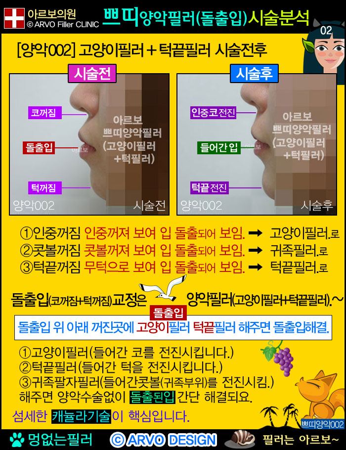 돌출입필러3가지,돌출입필러,쁘띠양악필러,고양이필러,턱끝필러,쁘띠양악필러전후설명